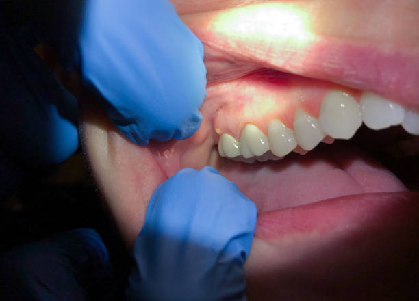Best Emergency Gum Treatment in Bren Arrow, OK